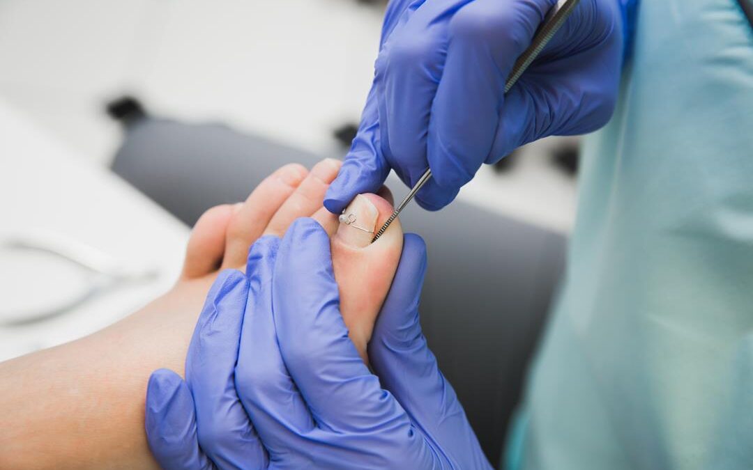 Klamry na wrastające paznokcie – dlaczego jest to tak popularna metoda leczenia?
