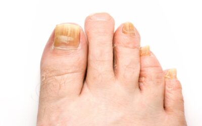 Problemy z płytką paznokcia, z którymi należy zgłosić się do podologa